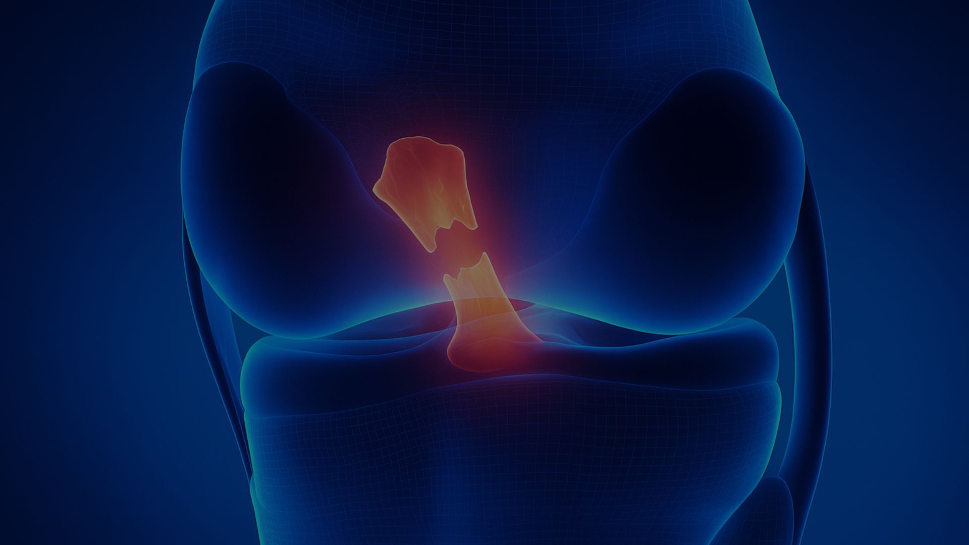 chirurgie des ligaments croisés