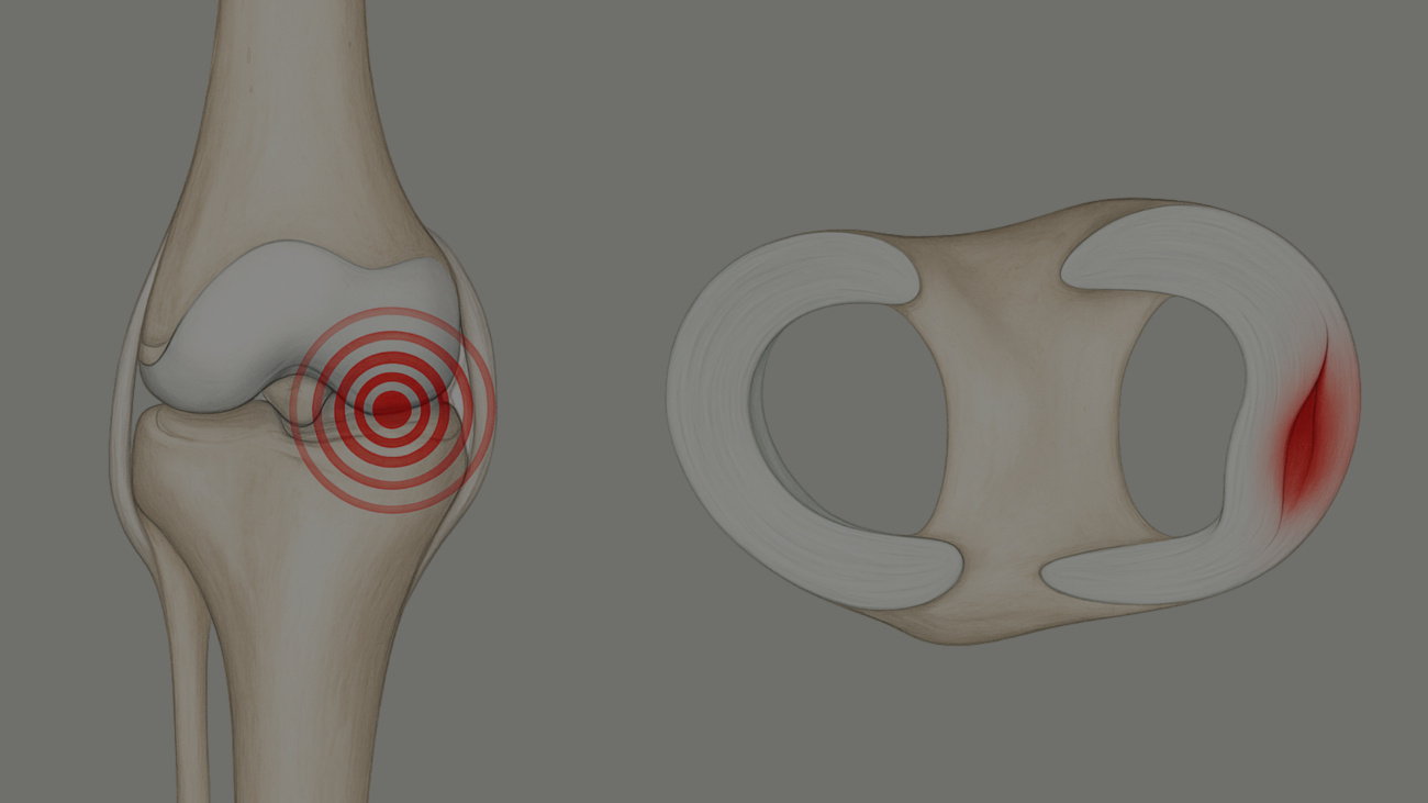 chirurgie des menisques