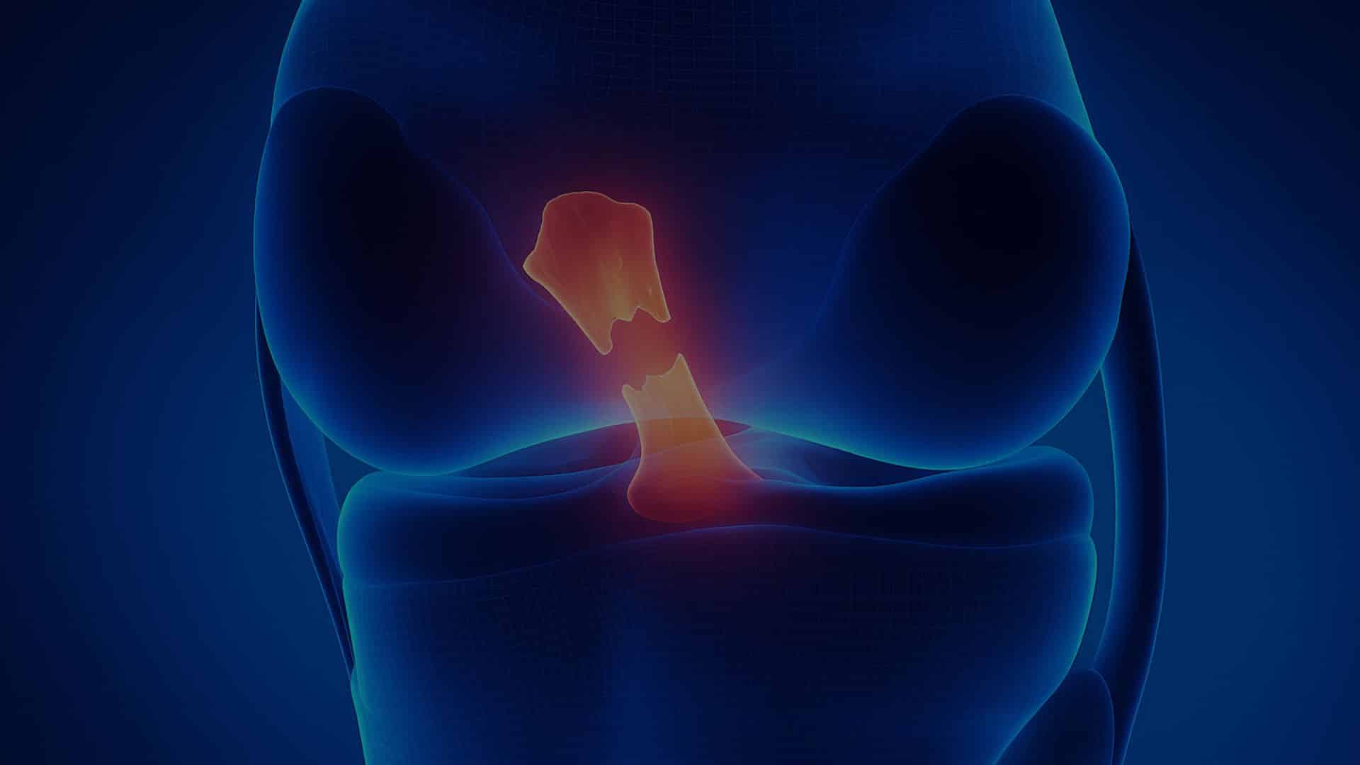 rupture du ligament croisé