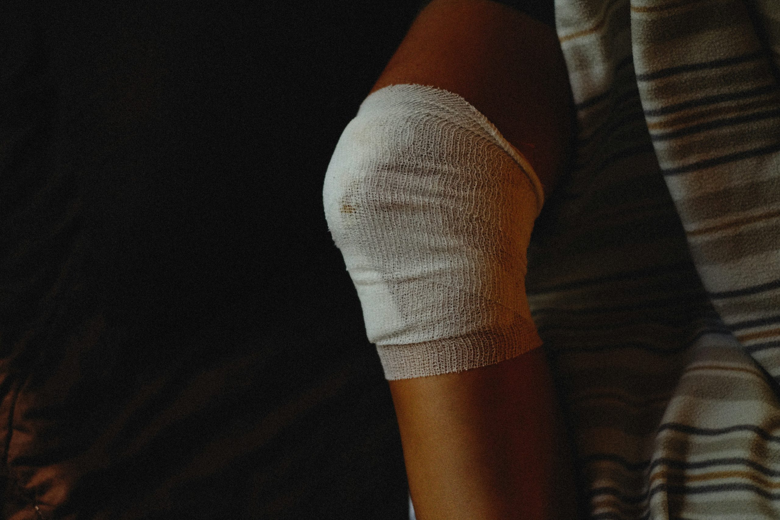 fracture du plateau tibial